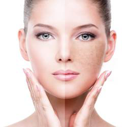 Anti-Pigmentation
