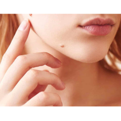 Mole Removal